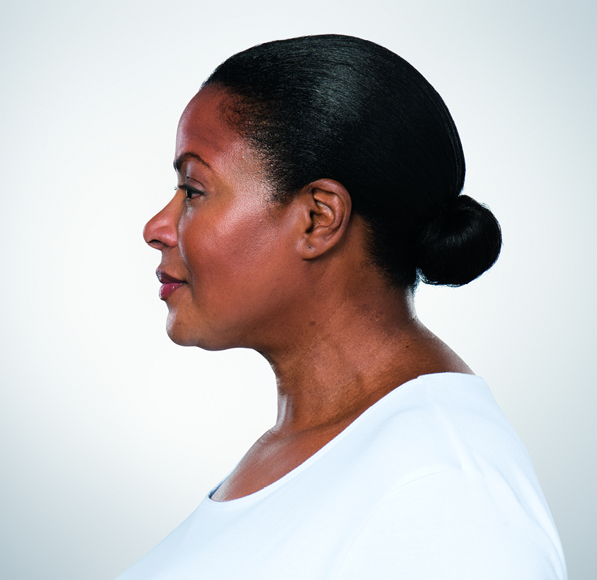 Kybella-After-Treatment